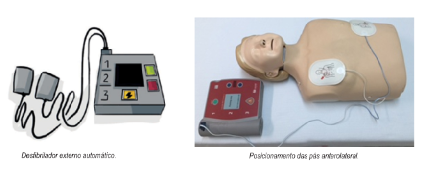 Ilustração e fotografia de um desfibrilador externo automático (DEA), mostrando o equipamento com pás/eletrodos e o posicionamento anterolateral dos eletrodos em um manequim para treinamento de desfibrilação.