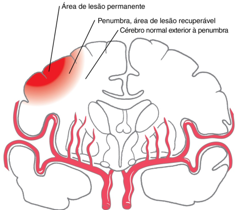 Ilustração médica em corte coronal do cérebro demonstrando os efeitos de uma isquemia. Na região superior esquerda do desenho, há uma área afetada com um gradiente de cor vermelha e três linhas indicativas com os textos: 'Área de lesão permanente' apontando para o centro vermelho escuro; 'Penumbra, área de lesão recuperável' apontando para a borda em vermelho claro; e 'Cérebro normal exterior à penumbra' apontando para o tecido saudável. Na base do cérebro, destaca-se o fluxo das artérias cerebrais em vermelho vivo.