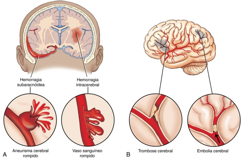 Infográfico explicativo dividido em duas partes que detalham os tipos de Acidente Vascular Encefálico (AVE). No lado esquerdo, indicado pela letra A, vê-se um corte frontal do cérebro ilustrando o AVE Hemorrágico, com indicações para 'Hemorragia subaracnóidea' e 'Hemorragia intracerebral'; círculos de zoom mostram um 'Aneurisma cerebral rompido' e um 'Vaso sanguíneo rompido'. No lado direito, indicado pela letra B, vê-se a vista lateral de um cérebro ilustrando o AVE Isquêmico, com duas áreas escurecidas; círculos de zoom detalham as causas como 'Trombose cerebral' (obstrução local) e 'Embolia cerebral' (coágulo transportado bloqueando o vaso, indicado por uma seta).