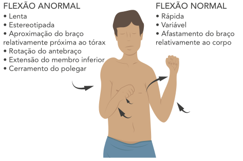 Ilustração comparando respostas motoras à flexão após estímulo físico. À esquerda, flexão anormal caracterizada por movimento lento e estereotipado, aproximação do braço ao tórax, rotação do antebraço, extensão do membro inferior e fechamento do polegar. À direita, flexão normal caracterizada por movimento rápido e variável, com afastamento relativo do braço em relação ao corpo. Setas indicam as direções dos movimentos.