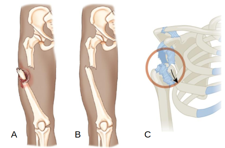 Uma ilustração médica dividida em três seções (A, B e C). A seção A mostra uma vista lateral da coxa humana; o osso fêmur está fraturado no meio, e uma das pontas do osso rompeu a pele, causando uma ferida aberta com sangramento. A seção B mostra a mesma coxa; o osso fêmur também está fraturado, mas as pontas permanecem dentro da coxa e a pele está intacta. A seção C mostra uma vista anterior da articulação do ombro e caixa torácica; a cabeça do osso úmero está completamente deslocada para baixo e para frente para fora de sua cavidade no osso escápula, com a área marcada por um círculo vermelho e uma seta indicando a direção do deslocamento.