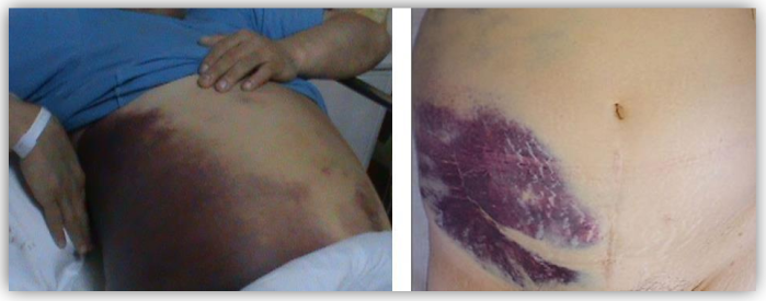 Fotografias clínicas demonstrando o sinal de Grey Turner. À esquerda, extensa equimose violácea na região lateral do abdome e flanco. À direita, área de equimose arroxeada localizada no flanco abdominal. O sinal indica possível hemorragia retroperitoneal e pode estar associado a traumatismos graves ou pancreatite aguda.