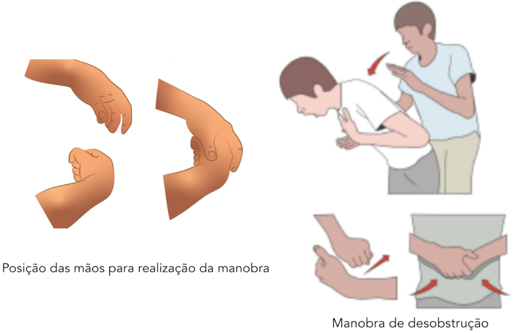 Ilustração demonstrando a manobra de Heimlich para desobstrução das vias aéreas em vítima consciente, com destaque para o posicionamento das mãos na região abdominal e a execução das compressões abdominais.
