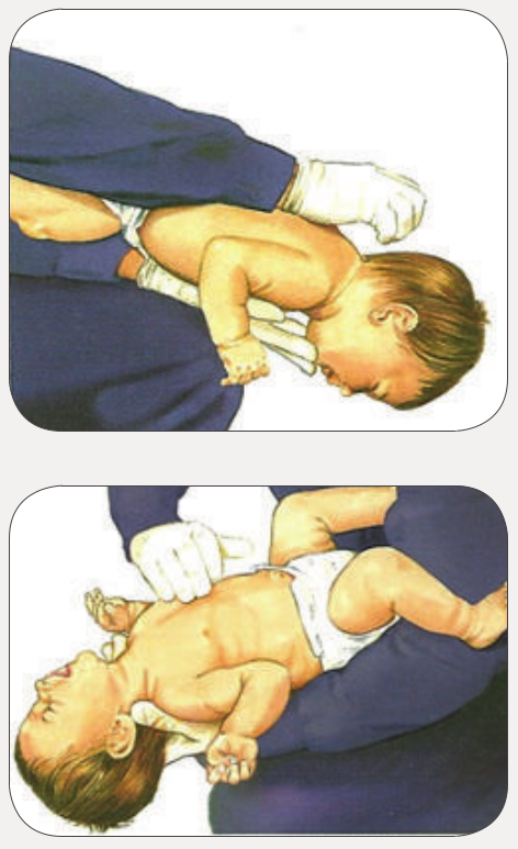 Ilustração em duas etapas da desobstrução das vias aéreas em lactente consciente. Na primeira imagem, o bebê é posicionado de bruços sobre o antebraço do socorrista para aplicação de golpes interescapulares. Na segunda, o lactente é colocado de costas para a realização de compressões torácicas.