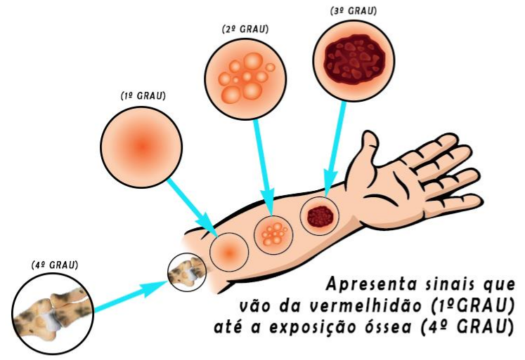 Ilustração dos graus de queimadura em um braço humano, mostrando lesões de primeiro, segundo, terceiro e quarto graus. O primeiro grau apresenta vermelhidão superficial; o segundo grau, formação de bolhas; o terceiro grau, destruição profunda da pele; e o quarto grau, comprometimento de tecidos profundos com exposição óssea. Setas indicam a localização e a progressão da gravidade das lesões.