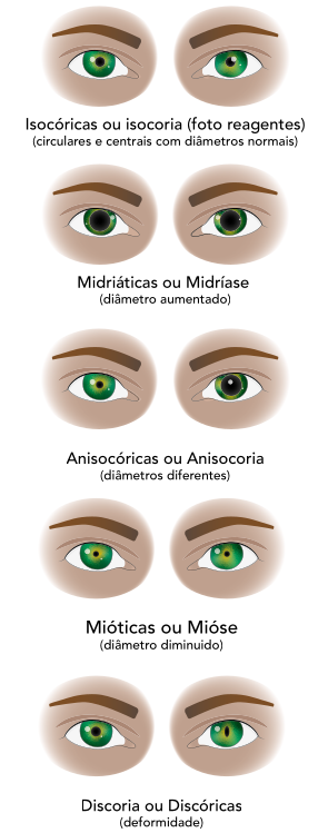 Ilustração comparativa dos principais tipos de pupilas: isocóricas (mesmo diâmetro e reação normal à luz), midriáticas (dilatadas), anisocóricas (diâmetros diferentes), mióticas (contraídas) e discóricas (deformadas), exibidas em pares de olhos com exemplos visuais de cada condição.