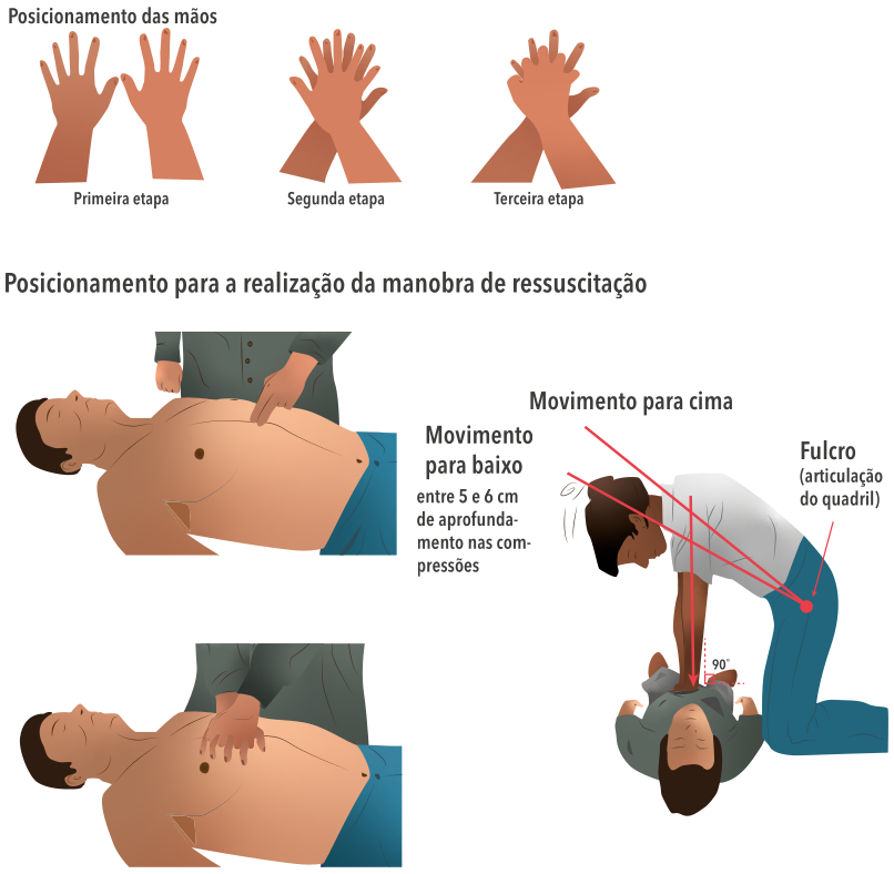 Ilustração das etapas para posicionamento das mãos e execução das compressões torácicas na ressuscitação cardiopulmonar (RCP). Na parte superior, apresenta três etapas de posicionamento das mãos sobrepostas para aplicação da força. Na parte inferior, mostra o socorrista realizando compressões no centro do tórax da vítima em decúbito dorsal e a mecânica corporal correta, com braços estendidos, ombros alinhados sobre as mãos e movimento vertical utilizando a articulação do quadril como fulcro.