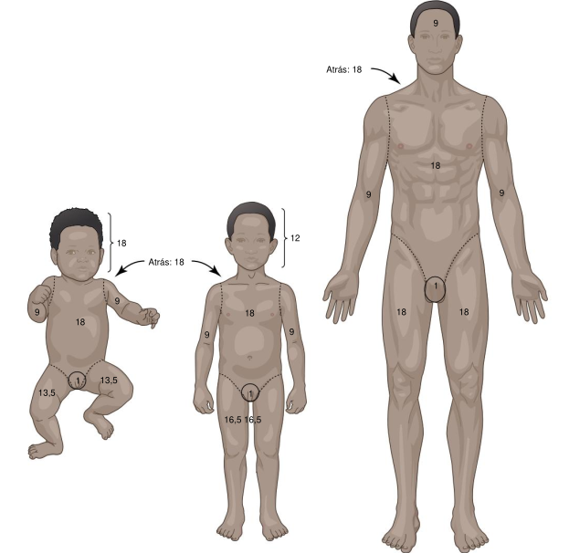 Ilustração da Regra dos Nove para estimativa da extensão de queimaduras, comparando a distribuição percentual da superfície corporal em lactente, criança e adulto, com valores atribuídos à cabeça, tronco, membros e região genital.