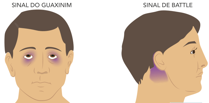 Ilustração médica digital apresentando dois sinais clínicos clássicos de traumatismo cranioencefálico. À esquerda, em vista frontal, o rosto de um homem exibe equimose periorbitária bilateral (manchas roxas ao redor de ambos os olhos), encimado pelo texto 'SINAL DO GUAXINIM'. À direita, em vista de perfil, a cabeça de uma pessoa exibe equimose na região do processo mastoide (mancha roxa atrás da orelha), encimado pelo texto 'SINAL DE BATTLE'.