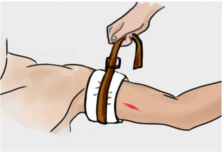 Ilustração mostrando a aplicação de um torniquete em um braço com sangramento, ajustado proximalmente ao local da lesão para interromper o fluxo sanguíneo e controlar a hemorragia.