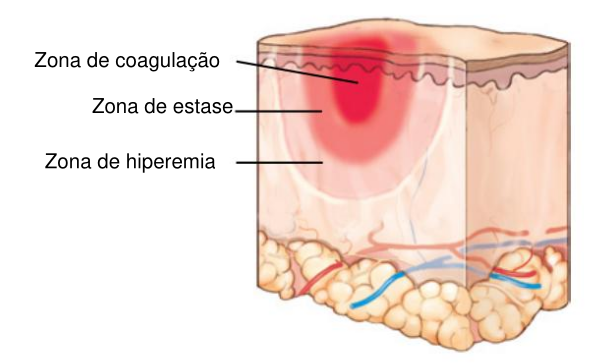 Ilustração em corte da pele mostrando as três zonas clássicas de uma queimadura: zona de coagulação no centro da lesão, zona de estase ao redor e zona de hiperemia na região mais periférica.
